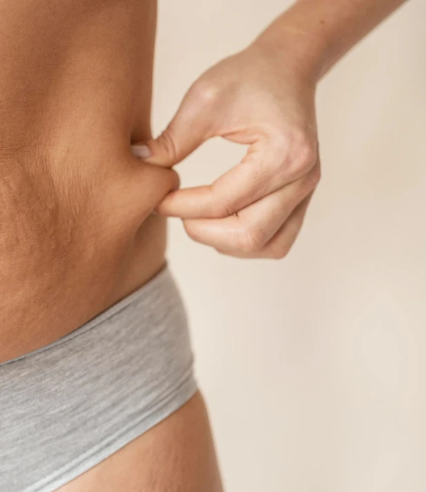 Mujer pellizcando un pliegue de piel en el abdomen antes de un tratamiento endoláser corporal
