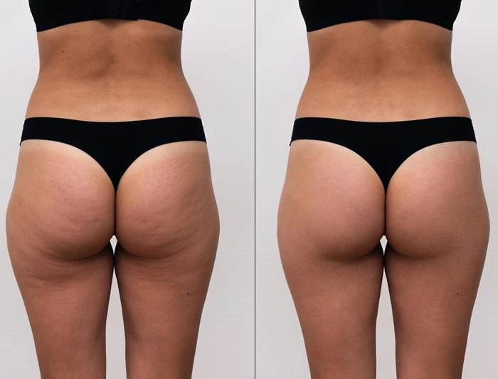 Antes y después de endoláser en glúteos en mujer, con mejora visible de firmeza y contorno corporal.