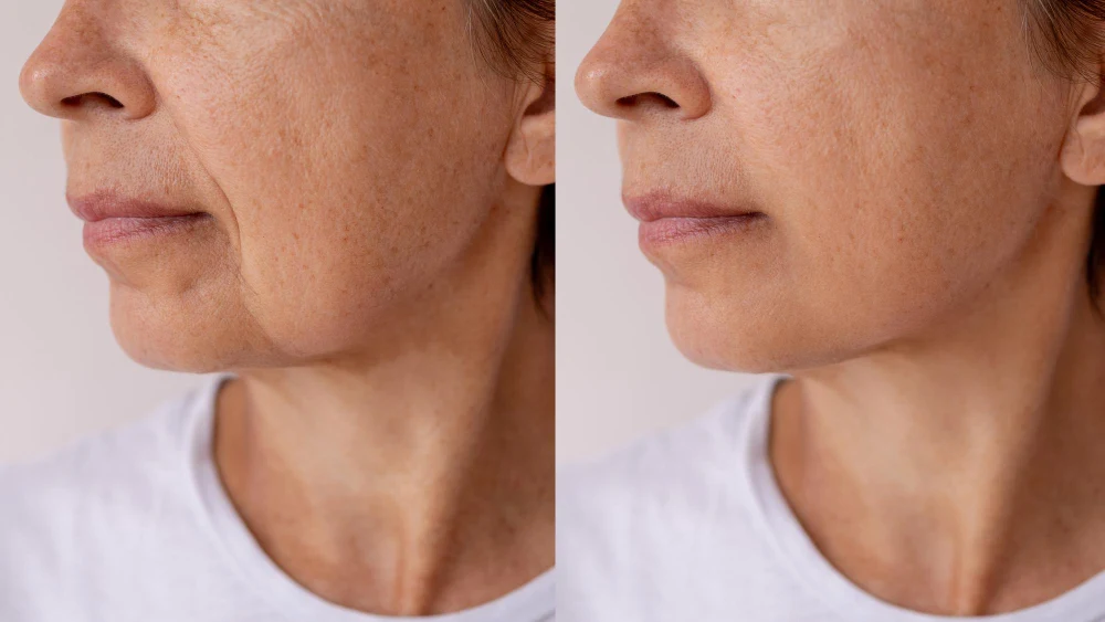 Comparativa antes y después de tratamiento endoláser facial en mujer, vista de perfil
