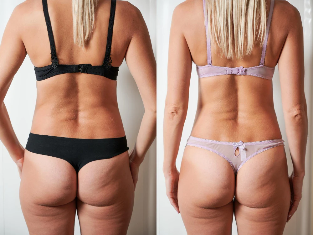 Antes y después de endoláser corporal en tronco y espalda en mujer, con mejora visible de firmeza y contorno.