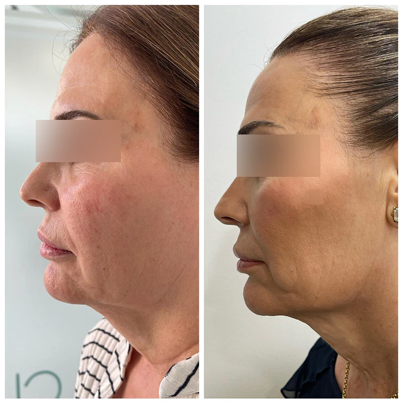 Antes y después de endolifting facial en Clínica Dimar, L'Hospitalet de Llobregat (Barcelona)
