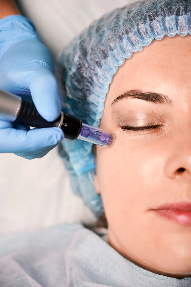 Antes y después de endolifting facial en tercio inferior y cuello, comparativa de perfil
