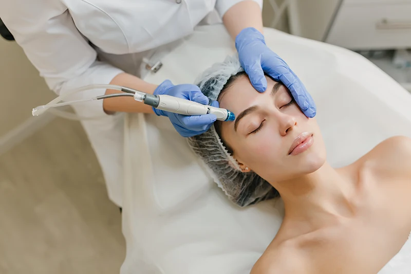 Antes y después de endolifting facial en mujer morena, comparativa del rostro